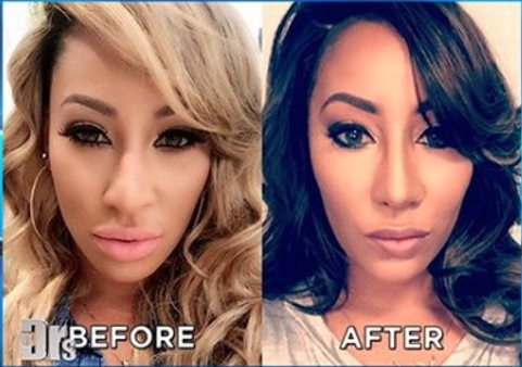Hazel E Nose Job Before and After Instagram