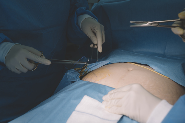 2 asian female surgeon and nurse conducting a surgery on an asian chinese senior woman on her abdomen in the operating room of hospital