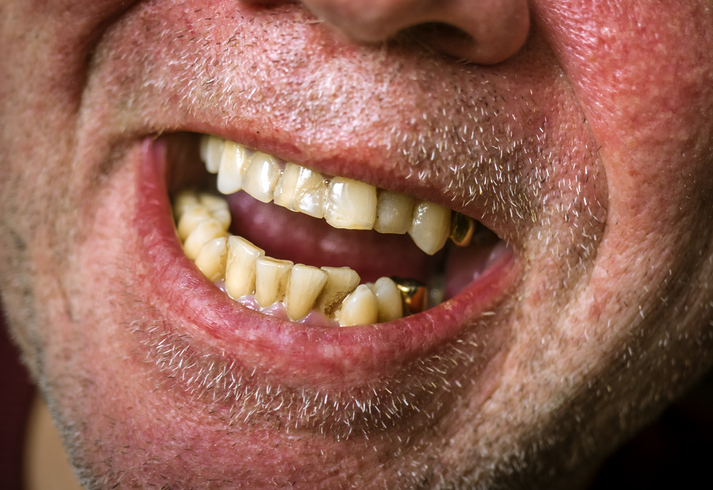 Close-Up Of Bad Teeth
